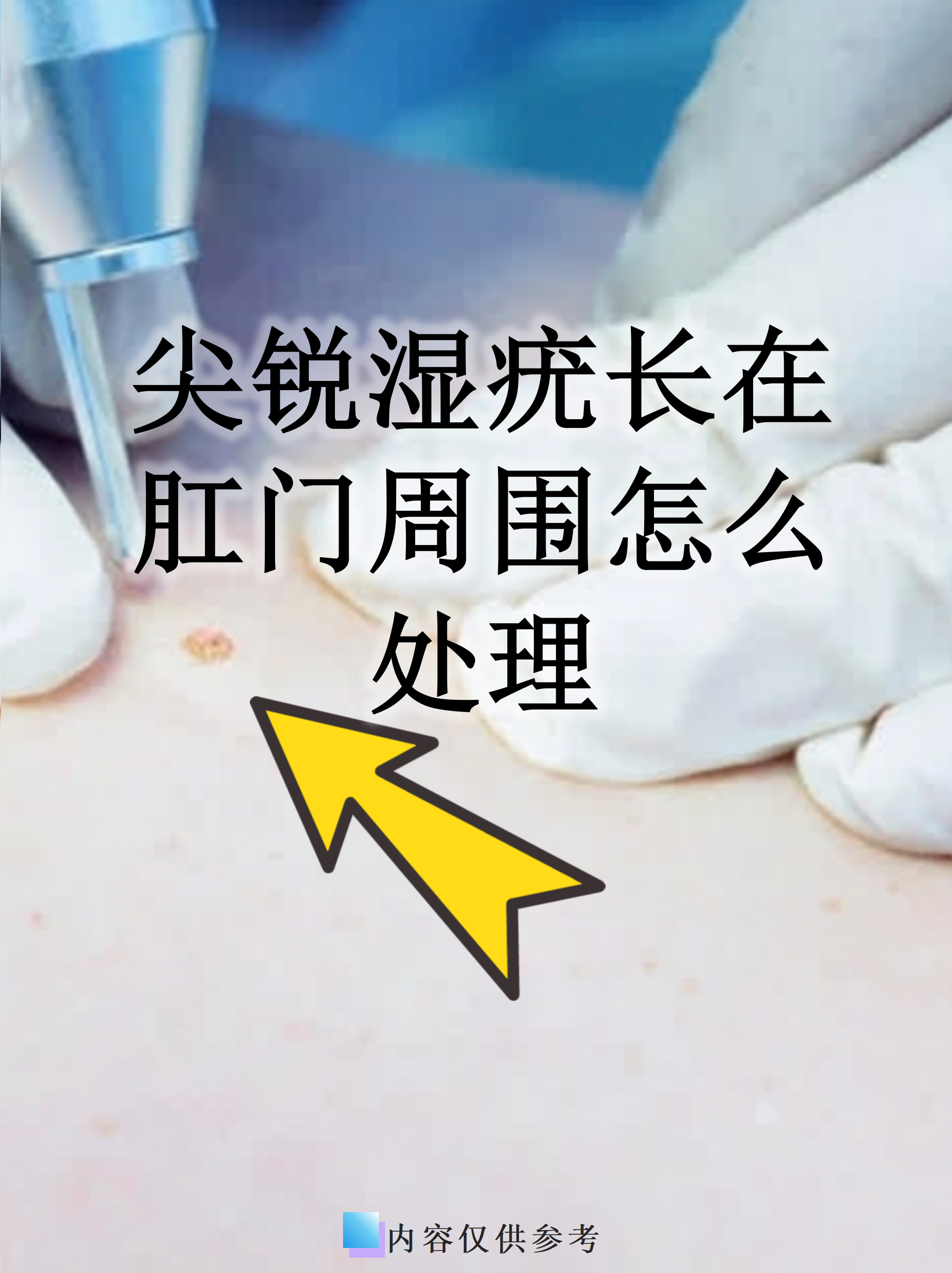 尖锐湿疣怎么治疗才能根治好治吗_(尖锐湿疣治疗最佳办法)  第1张