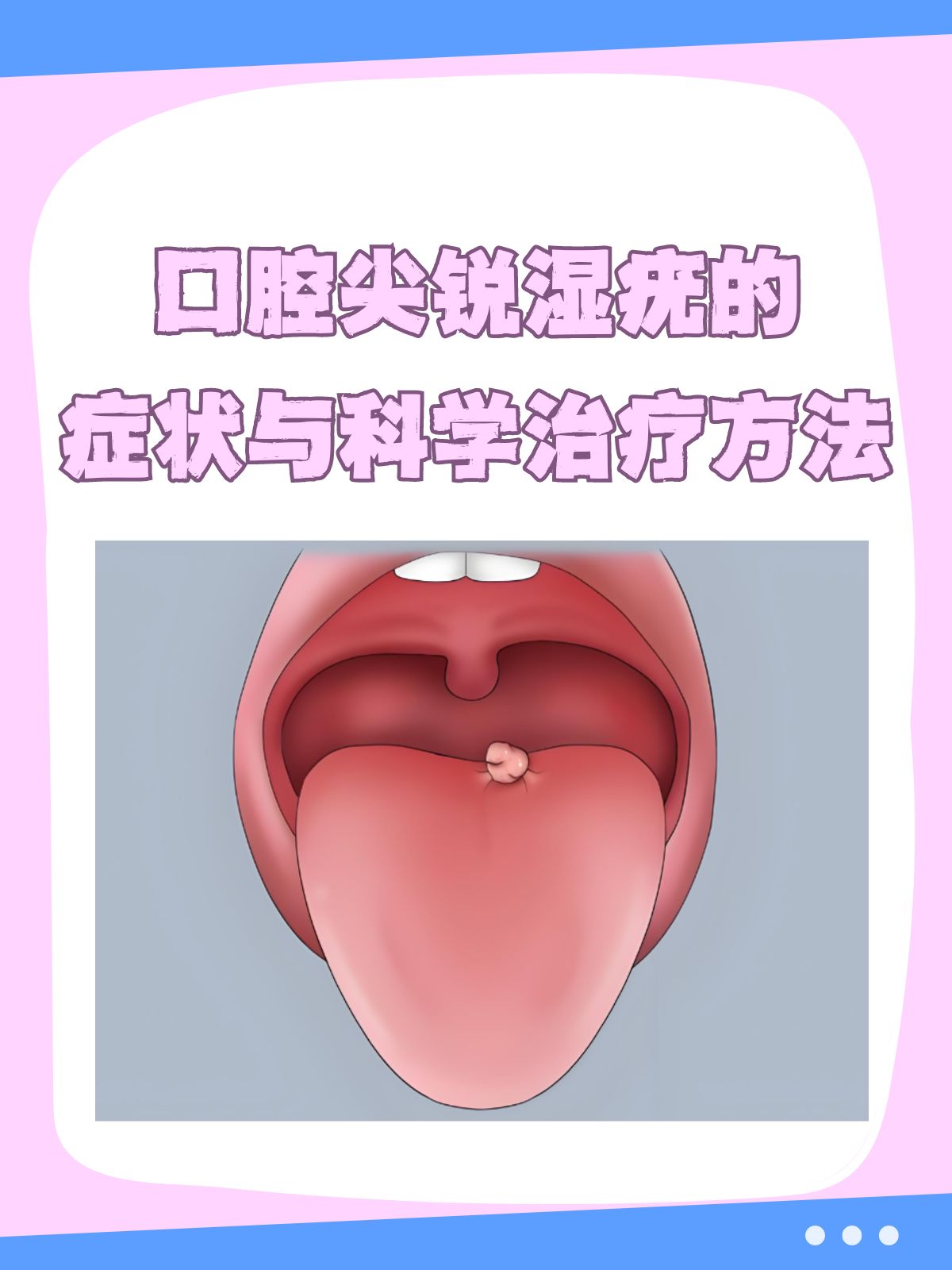 尖锐湿疣怎么治疗才能根治口腔_(尖锐湿疣怎么治疗才能根治口腔溃疡) 第1张 尖锐湿疣怎么治疗才能根治口腔_(尖锐湿疣怎么治疗才能根治口腔溃疡) 第1张
